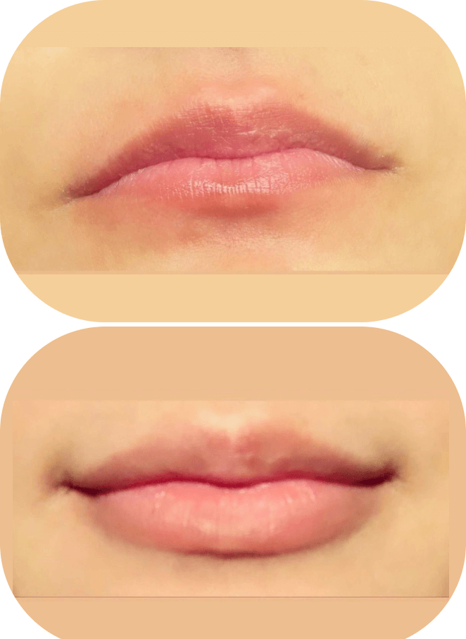 Lip-1 (1)