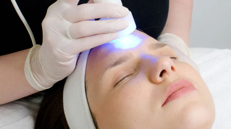 picture of laser facial being performed on a woman's face