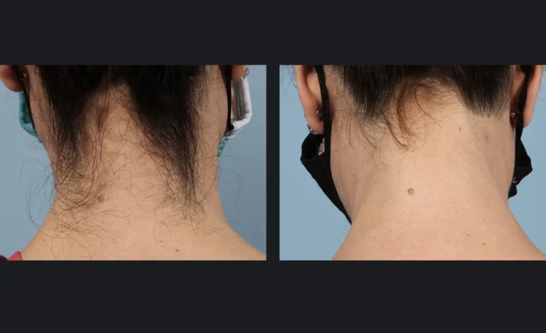 Laser hair removal neck before and after