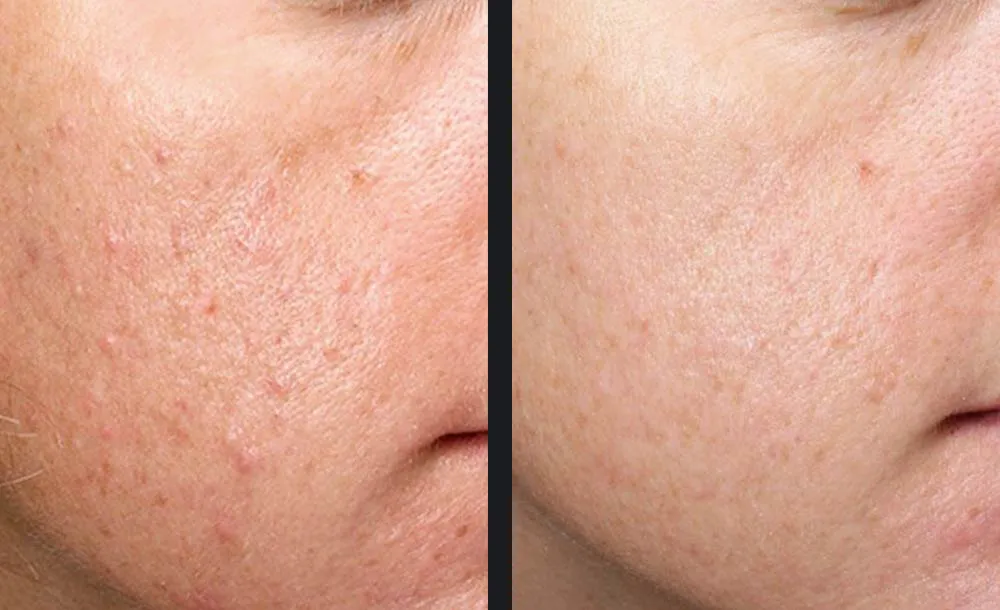 picture of before and after scar treatment with Candela exceed