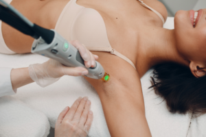 laser hair removal on armpit